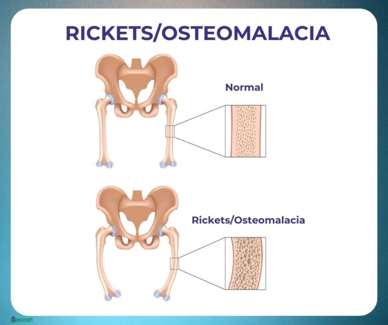 Osteomalacia Symptoms Causes Risk Groups Prevention And Treatment