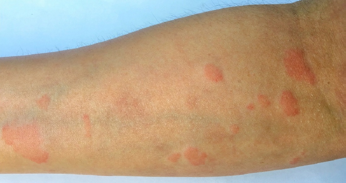 Ecosh_Common_Lupus_Symptoms_rash