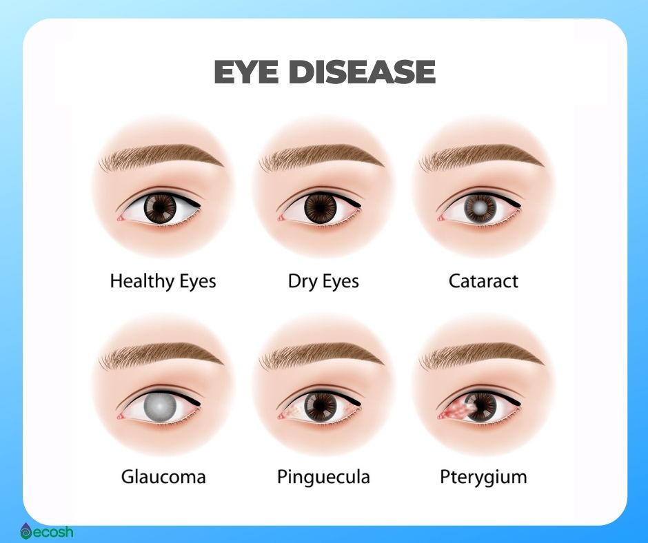 Ecosh_Eye_Diseases_Dry_Eyes_Pinguecula_Pterygium_Cataract_Glaucoma_Eye_Health_Eye_Vitamins