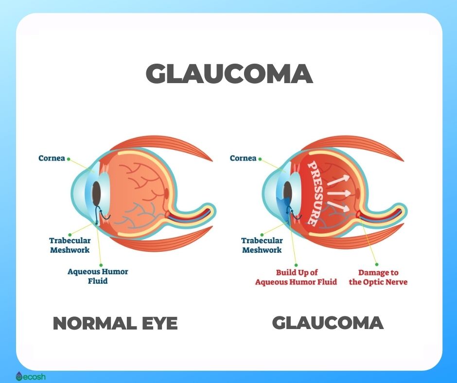 Ecosh_Eye_Diseases_Glaucoma_Eye_Health_Eye_Vitamins