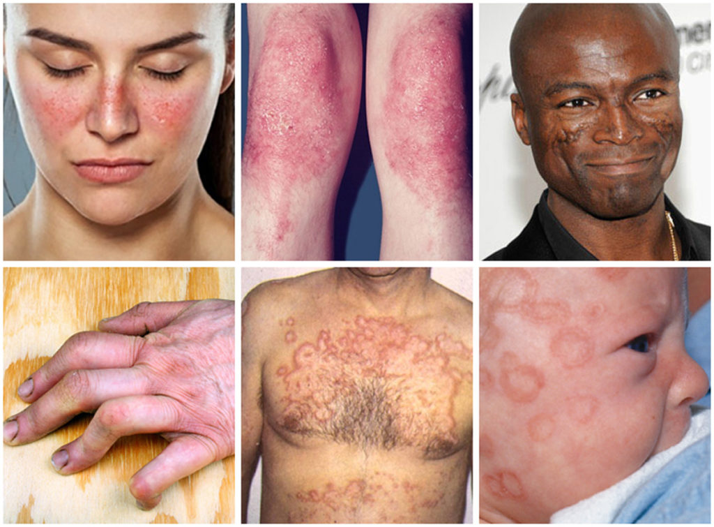 common-lupus-symptoms-rheumatoid-arthritis-treatment-natural-remedies