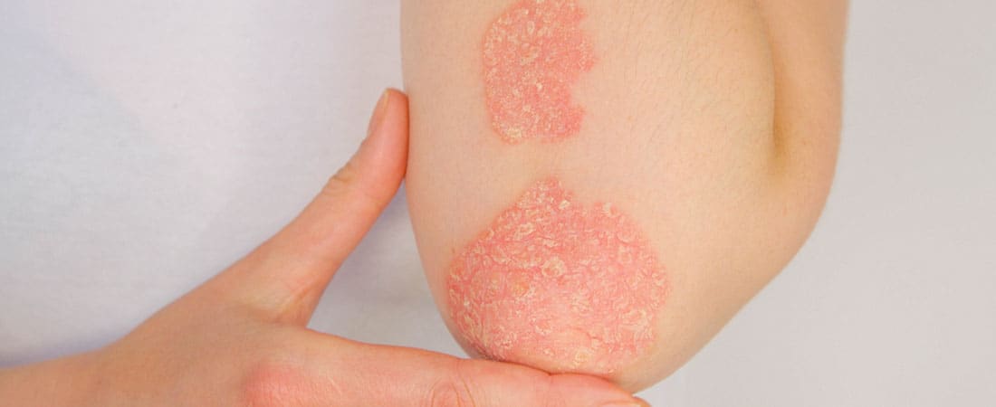 psoriasis