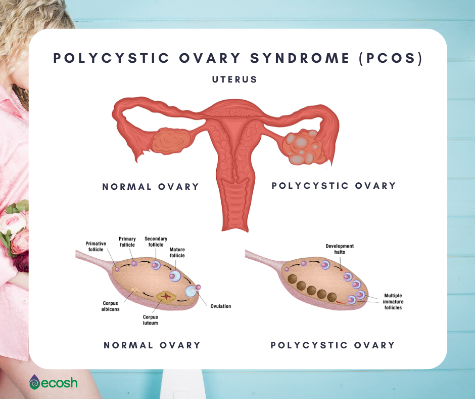 Ecosh_polycystic_ovary_syndrome_PCOS