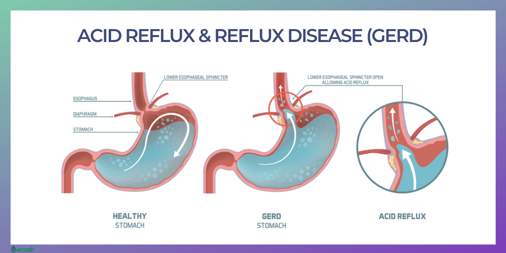 home remedies for acid relux