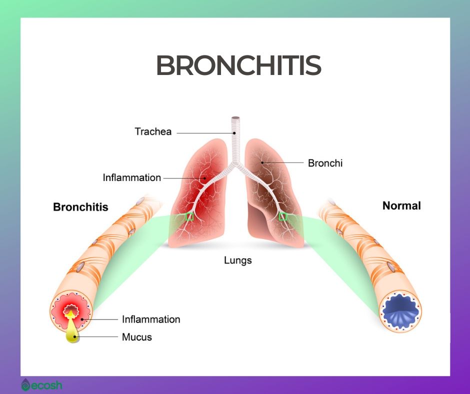 Bronchitis Causes, Symptoms, Emotions Behind Bronchitis and Natural Home Treatment