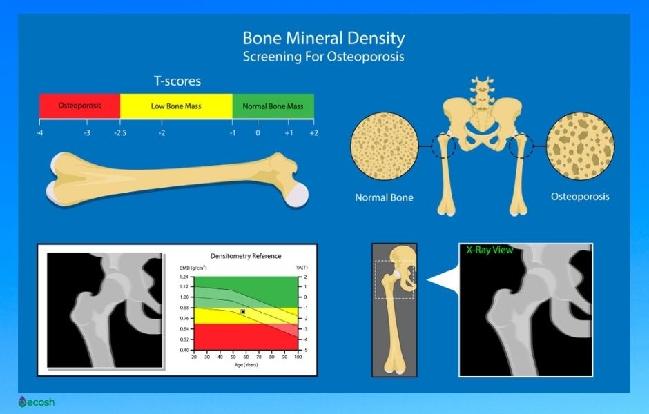 Osteoporosis Symptoms Causes Risk Groups Prevention And Treatment Ecosh