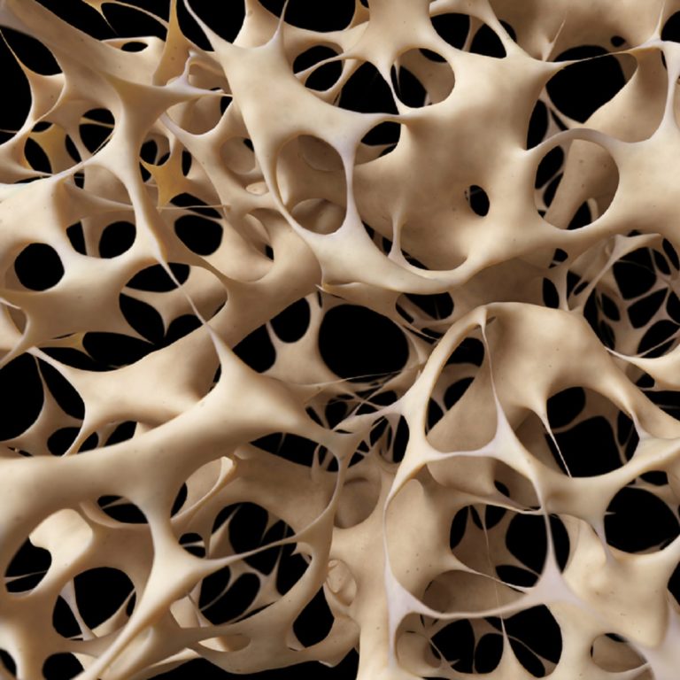 OSTEOPOROSIS – Symptoms, Causes, Risk Groups, Prevention and Treatment