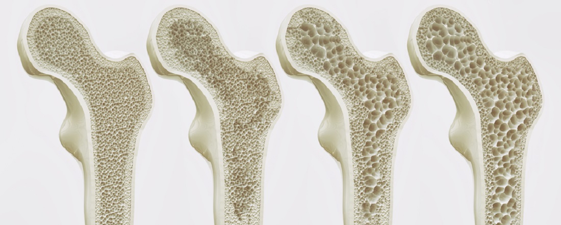 Osteopenia_Treatment_Osteoporosis_Treatment