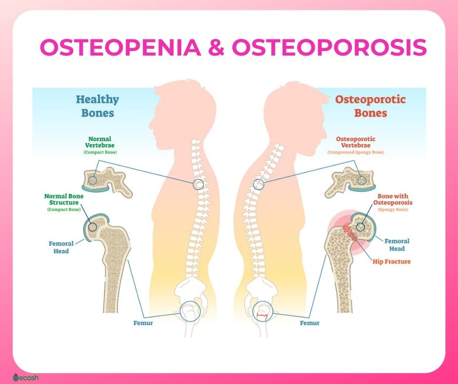 Osteopenia Symptoms Causes Risk Groups Prevention And Treatment Ecosh