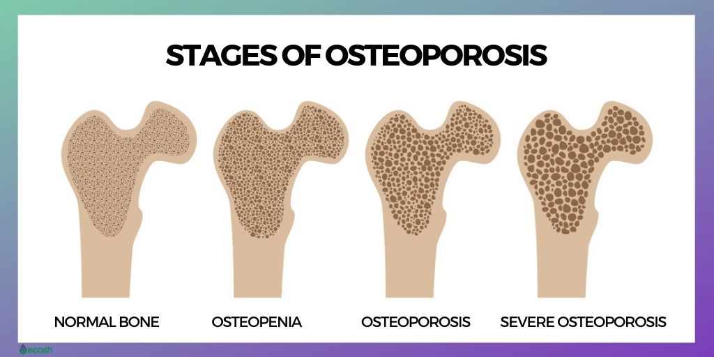 Osteoporosis_Stages_Normal_Bone_Osteopenia_Osteoporosis_Severe_Osteoporosis