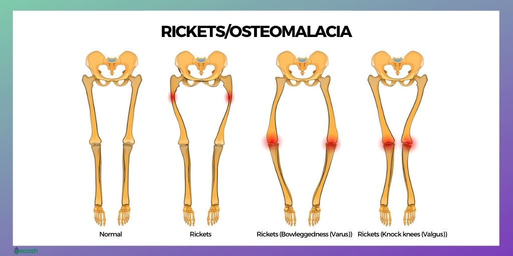 Rickets_Osteomalacia_Symptoms_Rickets_Types_Osteomalacia_Types_Varus_vs_Valgus_Bowleggedness_Rickets_Knock_knees_Rickets_Rickets_vs_Osteomalacia