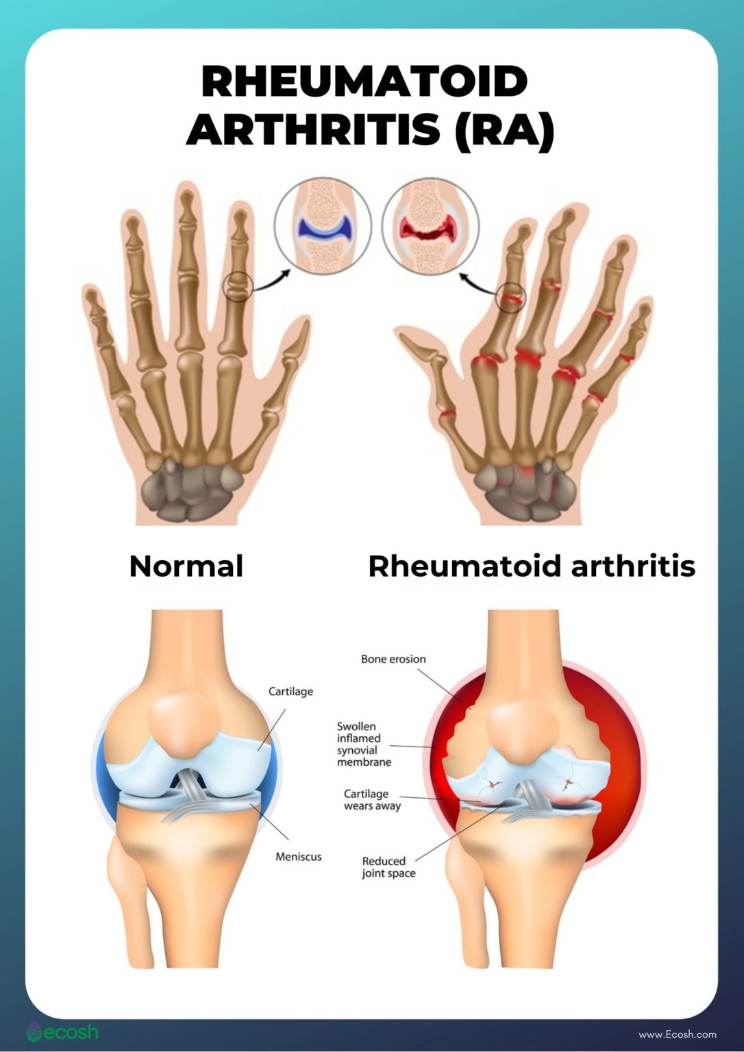 RHEUMATOID ARTHRITIS (RA) Symptoms, Causes, Risk Groups, Treatment