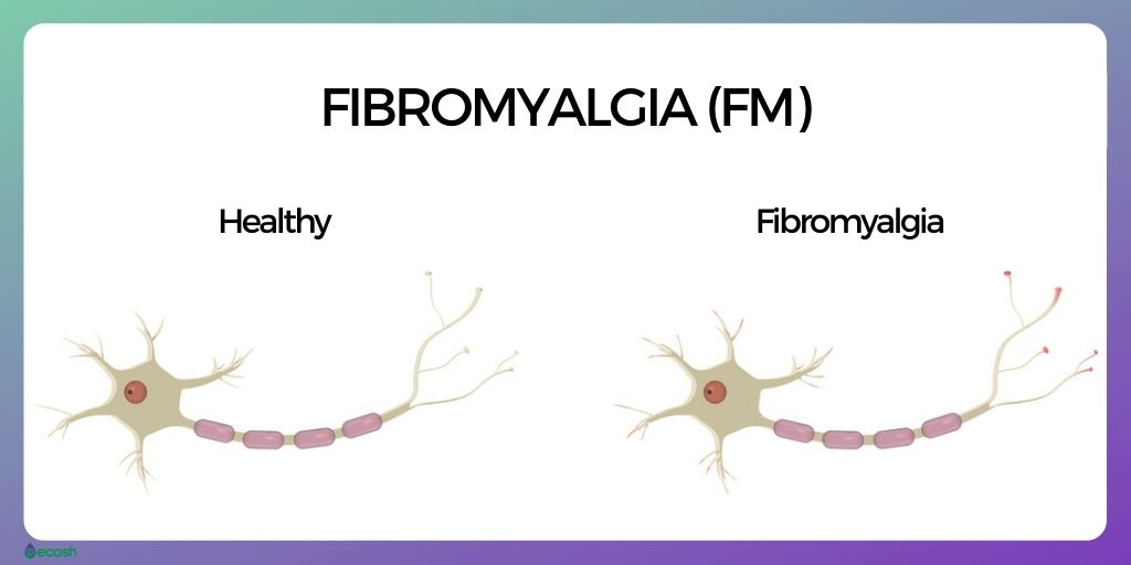 Fibromyalgia_Causes_Fibromyalgia_Risk_Factors_Fibromyalgia_Nerves_Fibromyalgia_and_Pain_Signals (2)