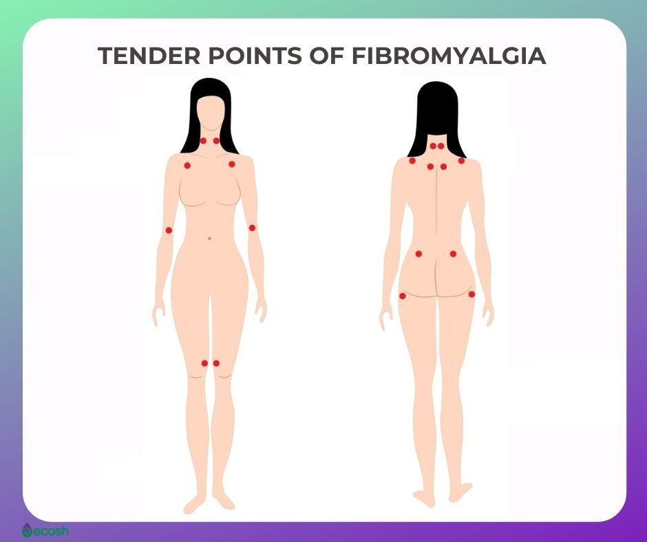 Fibromyalgia_Diagnosis_Tender_Points