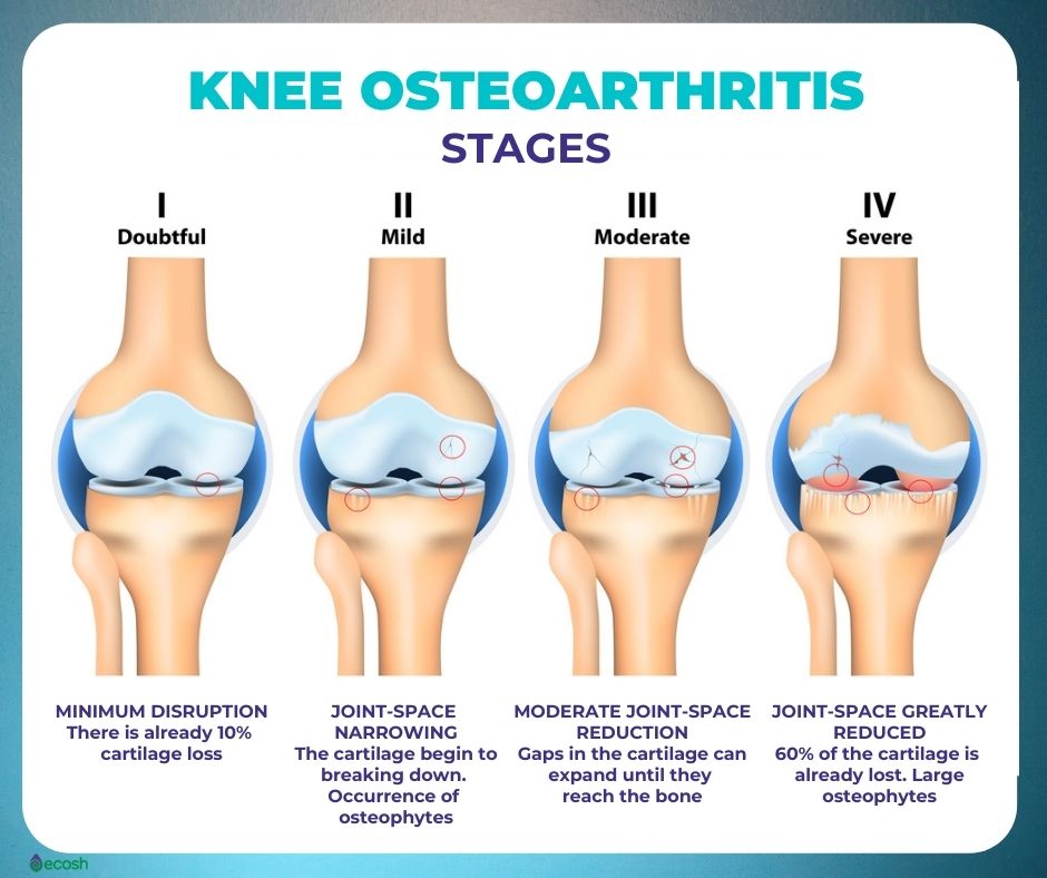 Osteoarthritis_4_Stages