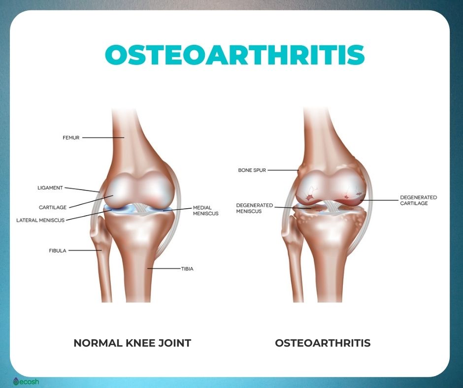 Osteoarthritis_Symptoms_Knee_Osteoarthritis