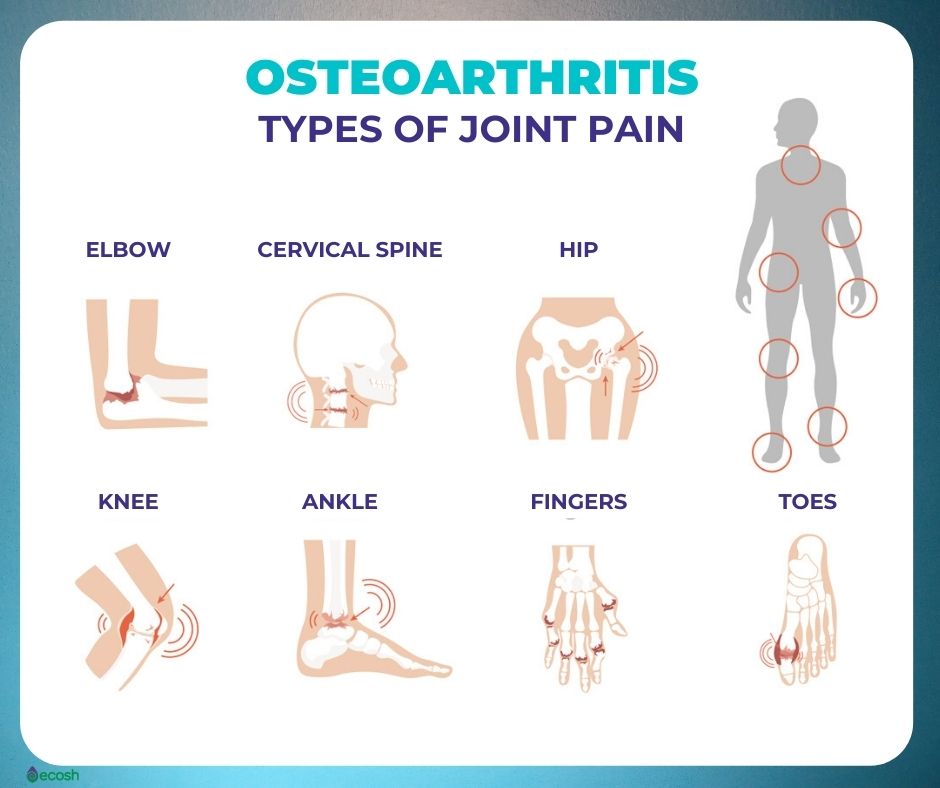 OSTEOARTHRITIS (OA) %u2013 Symptoms, Causes, Risk Groups, Prevention and Home Treatment - Ecosh