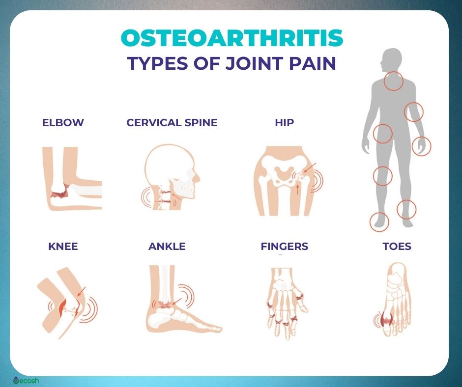 OSTEOARTHRITIS (OA) %u2013 Symptoms, Causes, Risk Groups, Prevention and Home  Treatment - Ecosh