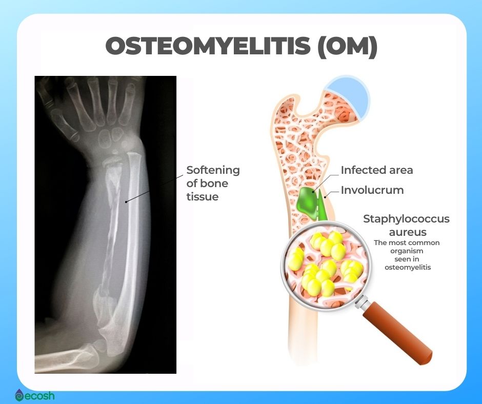 Osteomyelitis In The Lower Back