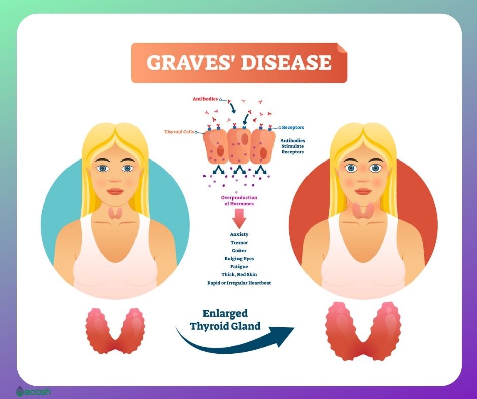 Graves_Disease_Symptoms_Goiter_Bulging_Eyes_Graves_Disease_Cauases