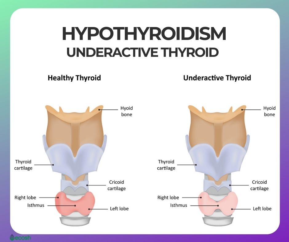 what causes underactive thyroid