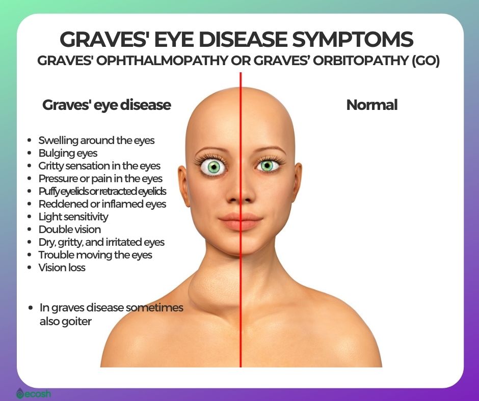 GRAVES' DISEASE Symptoms, Causes, Risk Groups, Conventional Treatment