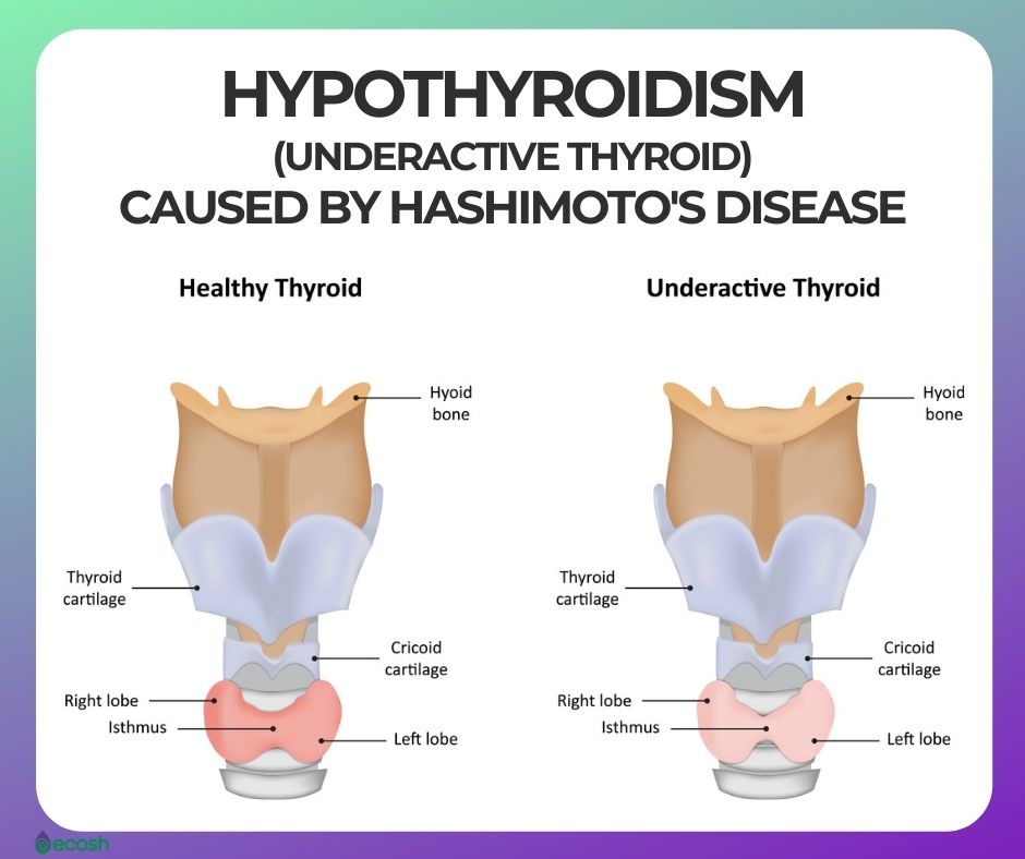 Hashimotos Disease Symptoms Causes Risk Groups Conventional Treatment Hashimotos Diet