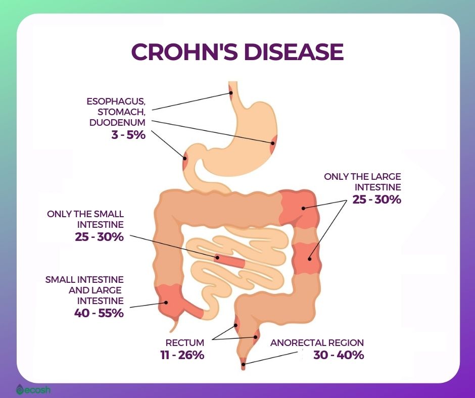Crohns_Disease_Infection_Areas_Crohns_Disease_Prevalence_Infected_Areas_In_Crohns_Disease