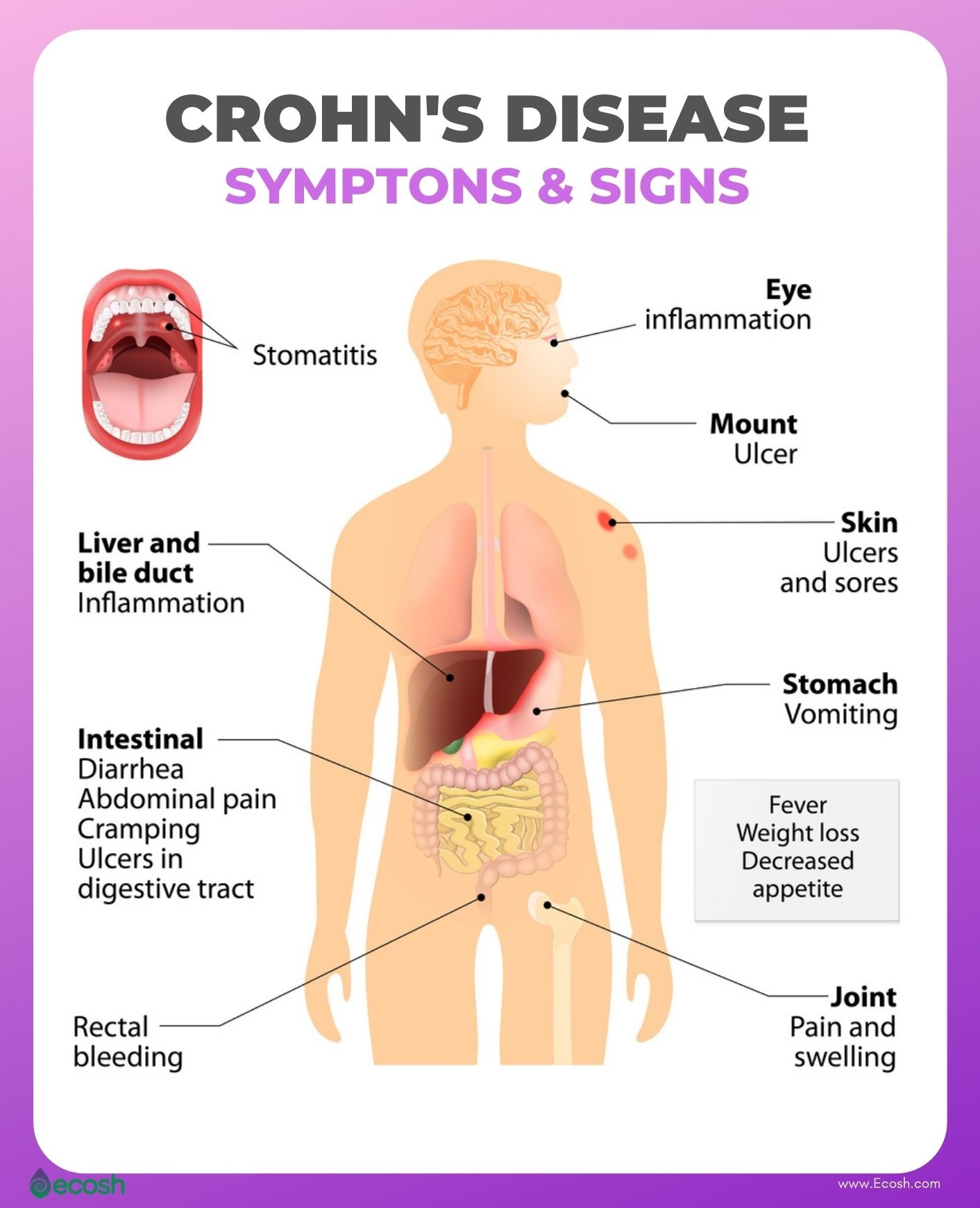 CROHN S DISEASE Symptoms Causes Risk Factors Crohn s Disease Diet 