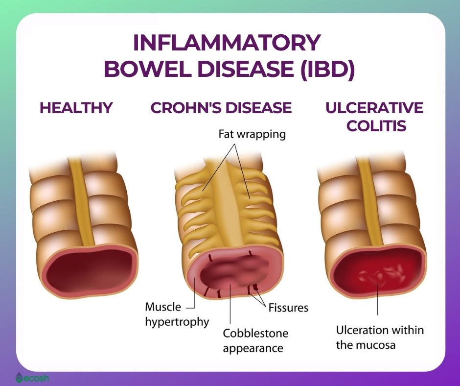 ULCERATIVE COLITIS UC Symptoms Causes Risk Factors Ulcerative 