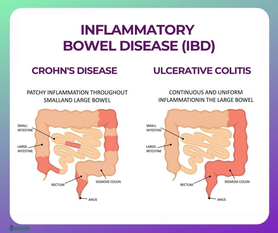 Inflammatory_Bowel_Disease_IBD_Difference_Between_Crohns_Disease_and_Ulcerative_Colitis_Bowel_Infection_Types_Bowel_Diseases_Gastrointestinal_Inflammation_Bowel_Inflammation