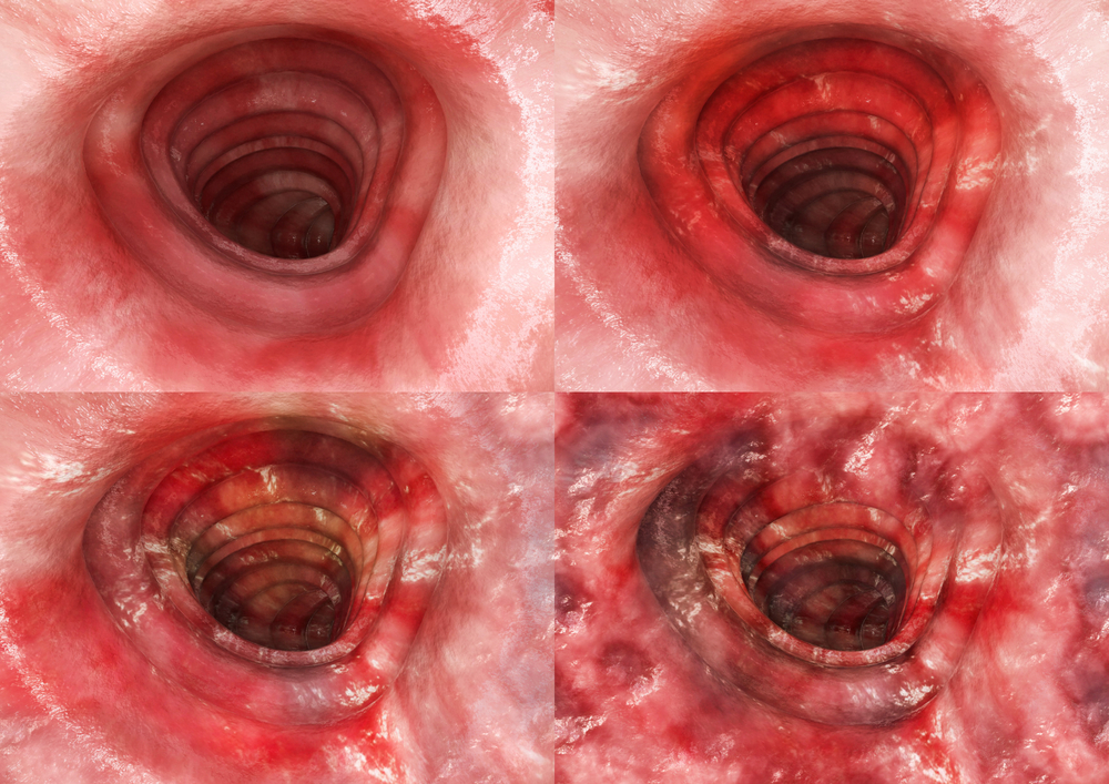 Ulcerative_Colitis_Stages_Ulcerative_Colitis_Types