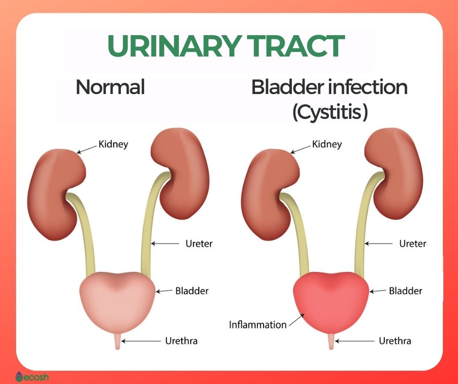 Urinary Tract Infection Cystitis Bladder Highlighted On The My Xxx Hot Girl 