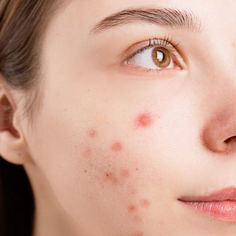 ACNE – Symptoms, Causes, Complications, and Treatment
