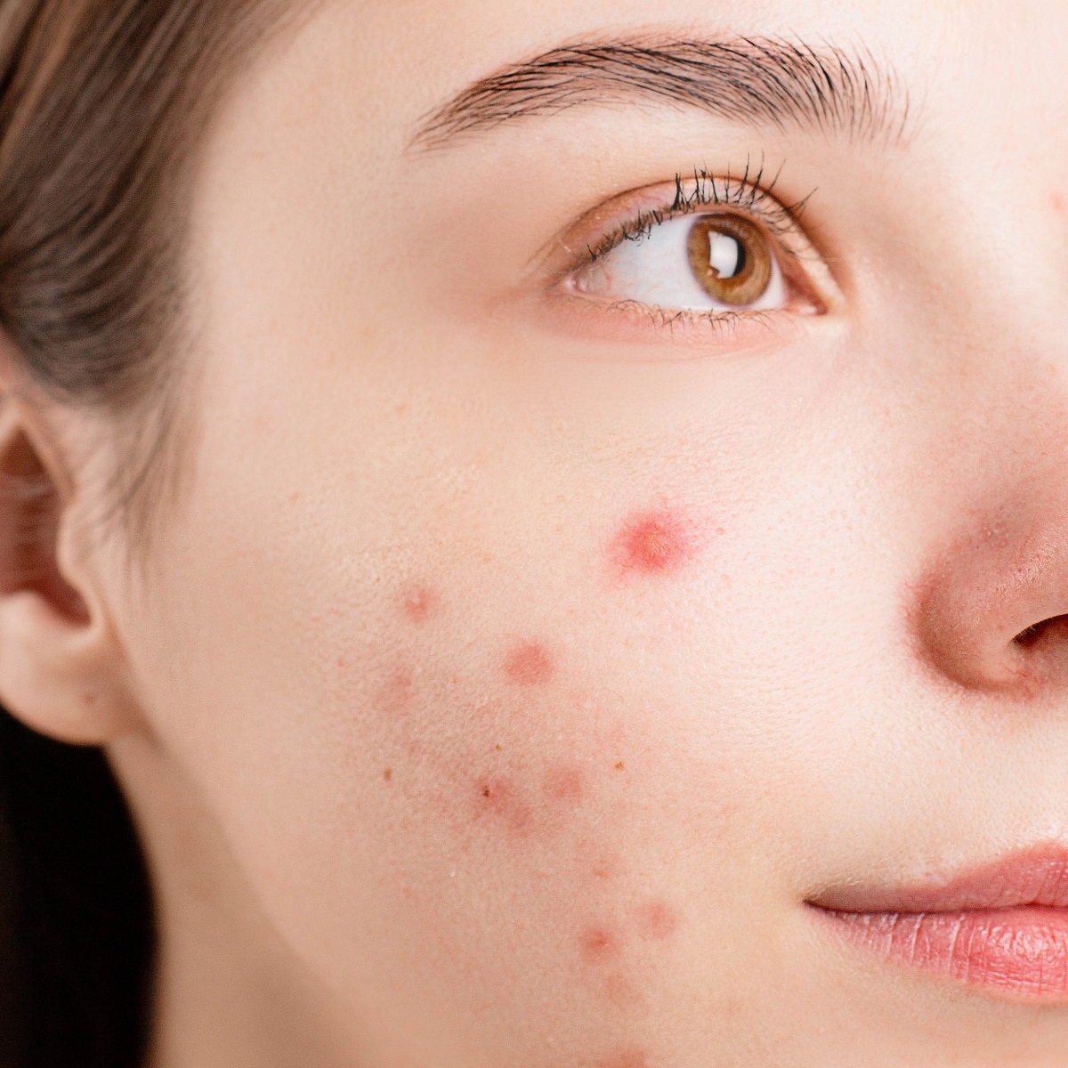 ACNE – Symptoms, Causes, Complications, and Treatment