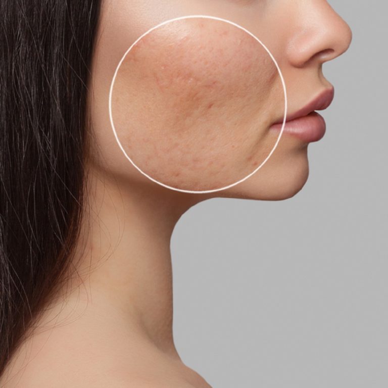 ACNE SCARS – Types of Acne Scars And Acne Scars Treatment