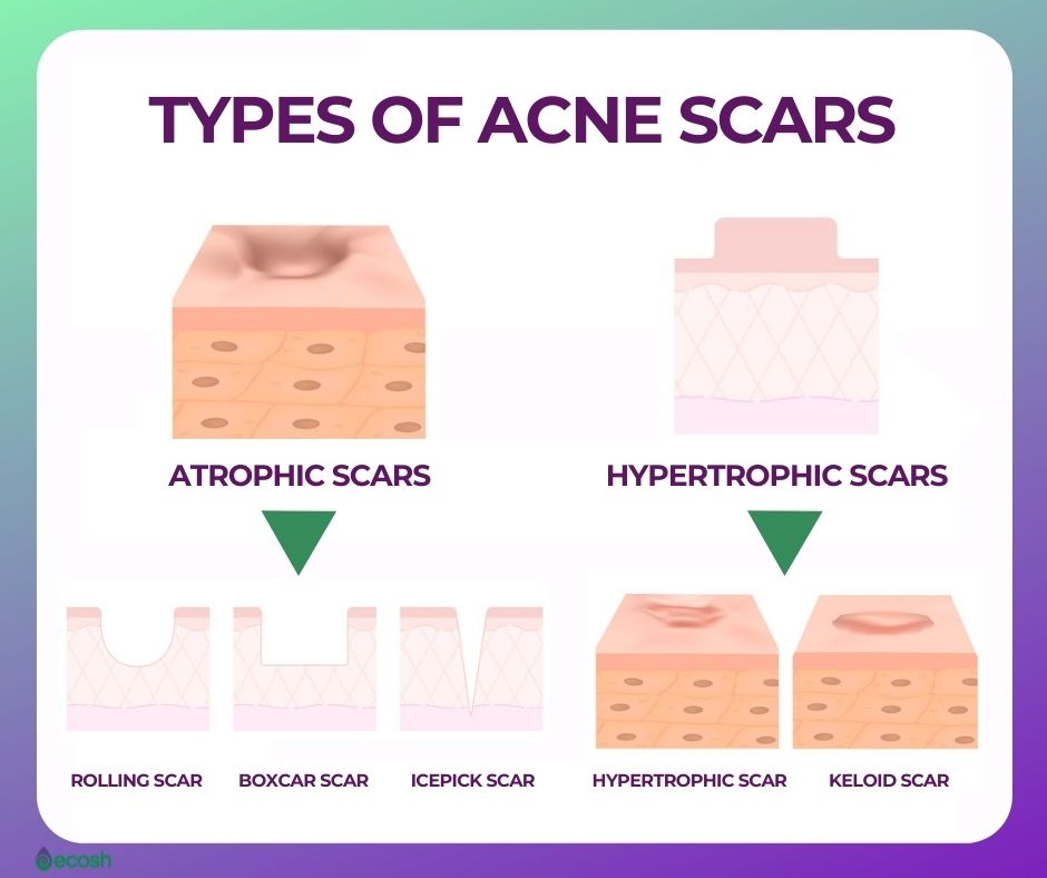 hypertrophic acne scar