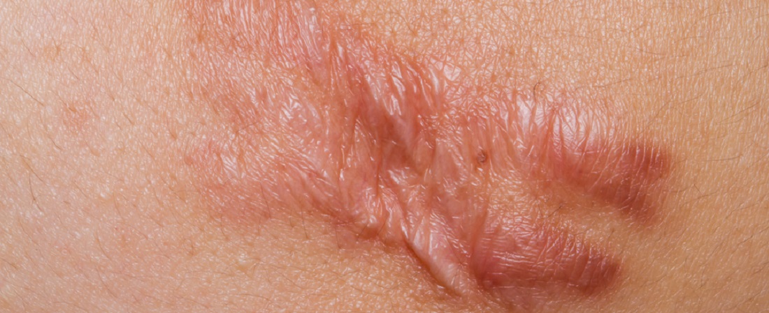 Keloid Scar