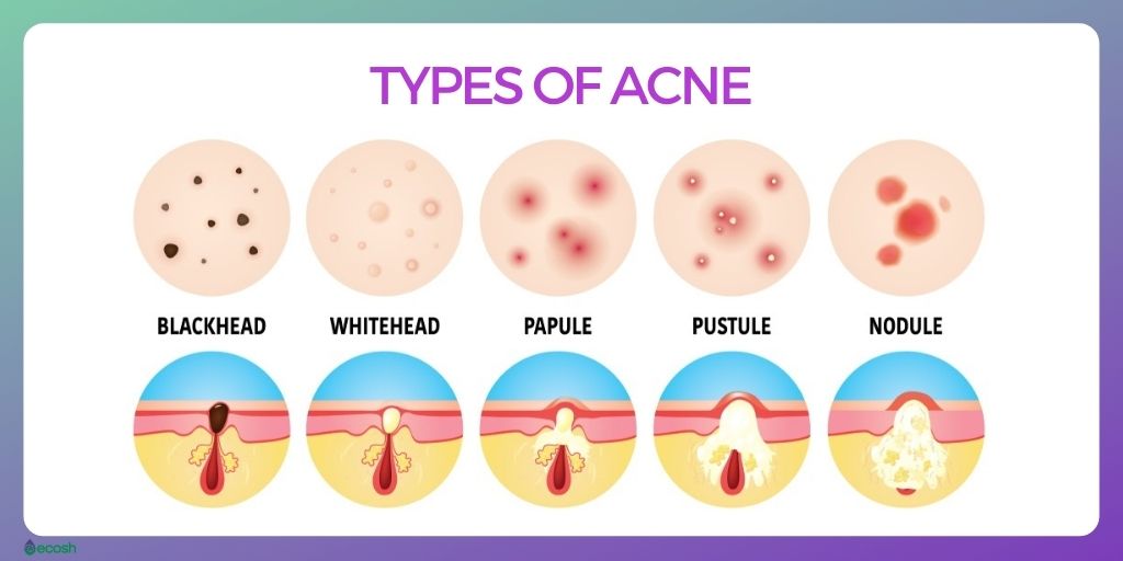 Types_of_Acne