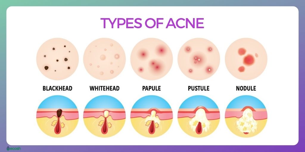 ACNE - Symptoms, Causes, Complications, and Treatment - Ecosh